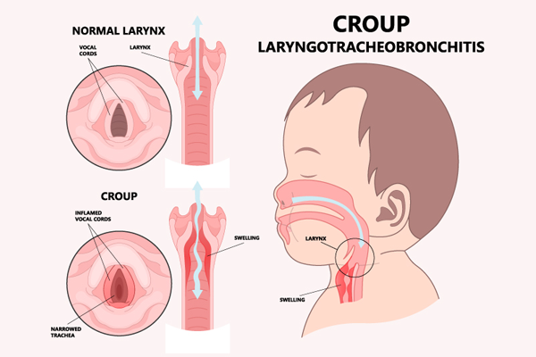 Croup (Laryngotracheobronchitis)