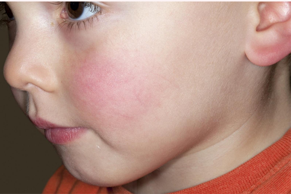 Images Of Slapped Cheek Disease